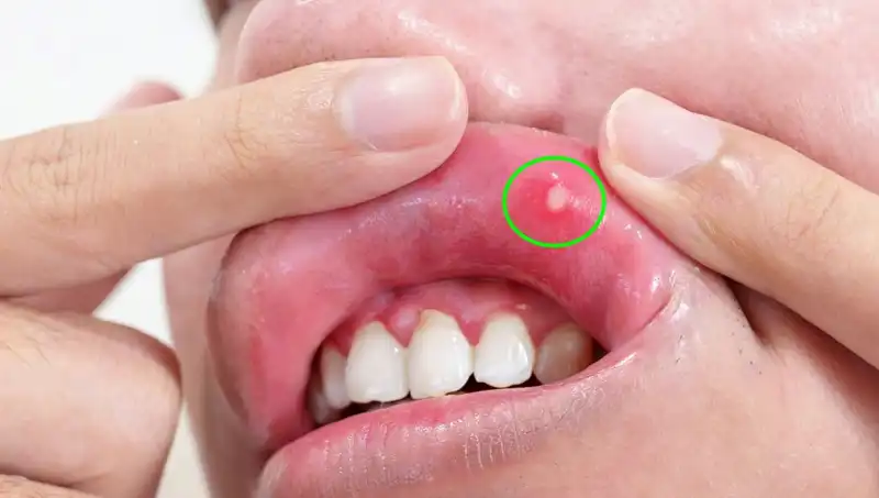 Vücudunuzun İhtiyacı Olan 5 Belirgin B Vitamini Eksikliği Belirtisi