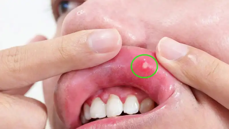 Dilinin Alınması Gereken Bu Genç Kadının Kanser Hikayesi Şaşkına Çeviriyor